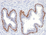 p63 Antibody Clone TP63/11 Prostate Cancer IHC. Immunohistochemistry analysis of Tumor protein 63 (TP63) in FFPE human prostate cancer tissue using a mouse monoclonal p63 antibody (clone TP63/11) demonstrates strong HRP-DAB brown nuclear staining in basal epithelial cells surrounding glandular structures, while malignant epithelial cells within the glands remain negative. This basal-restricted nuclear staining pattern is consistent with the role of TP63 as a basal cell marker and highlights the absence of a basal cell layer in prostate carcinoma. The crisp nuclear signal with low background supports clear interpretation of epithelial architecture and cell lineage. Heat-induced epitope retrieval was performed by boiling tissue sections in pH 9 10mM Tris with 1mM EDTA for 10-20 minutes followed by cooling at room temperature for 20 minutes prior to antibody incubation.
