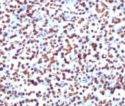 SOX9 Antibody Pancreas Tumor Progression IHC. Immunohistochemistry analysis of FFPE human pancreas using SOX9 Antibody. Mouse monoclonal antibody clone SRYB9-1 demonstrates strong nuclear HRP-DAB brown staining in epithelial cell populations, consistent with SOX9 expression in proliferative and tumor progression-associated compartments. Staining highlights clusters of cells with increased nuclear signal, while surrounding stromal elements show minimal reactivity, providing clear contrast. The observed pattern supports SOX9 as a tumor progression marker in pancreatic tissue. Heat-induced epitope retrieval was performed using pH 9 Tris-EDTA buffer to optimize nuclear antigen detection.