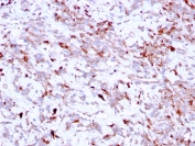 Cathepsin K Lysosomal Protease Antibody Hepatic Stromal Region IHC. Immunohistochemistry analysis of FFPE human liver tissue using Cathepsin K Antibody (clone CTSK/2791) shows granular cytoplasmic staining in scattered stromal and sinusoidal-associated cells, consistent with CTSK / Cathepsin K localization in lysosomal compartments. The punctate staining pattern reflects localized protease activity linked to tissue remodeling, while adjacent hepatocytes exhibit relatively low background signal. Hematoxylin counterstain provides nuclear contrast and architectural context. HIER: boil FFPE tissue sections in pH 6, 10 mM citrate buffer, for 10-20 min followed by cooling at RT for 20 min.