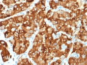 AMACR Antibody Renal Carcinoma IHC. Immunohistochemistry staining of FFPE human renal carcinoma tissue using clone AMACR/1864 demonstrates strong diffuse granular cytoplasmic HRP-DAB brown staining in malignant epithelial cells, consistent with the established carcinoma-associated expression pattern of Alpha-methylacyl-CoA racemase / AMACR in renal malignancy tissue. Required HIER: steam section in pH6 citrate buffer for 20 min and allow to cool prior to staining.