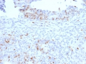 RAD51 Antibody Colon Carcinoma IHC. Immunohistochemical staining of FFPE human colon carcinoma demonstrates RAD51 expression using a RAD51 antibody. RAD51, also known as a Homologous Recombination Protein, is a key mediator of DNA double strand break repair and maintenance of genomic stability. Predominantly nuclear staining is observed in neoplastic cells, consistent with the elevated DNA repair activity frequently associated with proliferating tumors. Heat induced epitope retrieval was performed by boiling tissue sections in pH 9 10 mM Tris buffer containing 1 mM EDTA for 10 to 20 minutes followed by cooling prior to staining. These results support the utility of RAD51 Antibody for investigating homologous recombination, DNA damage responses, and therapeutic resistance in human cancers.