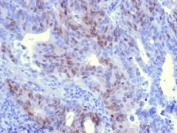 RAD51 Antibody Colon Carcinoma IHC. Immunohistochemical staining of FFPE human colon carcinoma demonstrates RAD51 expression using a RAD51 antibody. RAD51, also known as a Homologous Recombination Protein, is a central mediator of DNA double strand break repair and maintenance of genomic stability. Strong nuclear staining is observed in malignant epithelial cells, consistent with the elevated homologous recombination activity and proliferative capacity characteristic of colorectal tumors. Heat induced epitope retrieval was performed by boiling tissue sections in pH 9 10 mM Tris buffer containing 1 mM EDTA for 10 to 20 minutes followed by cooling prior to staining. These results support the utility of RAD51 Antibody for investigating DNA damage responses, homologous recombination, and therapeutic resistance in human cancers.