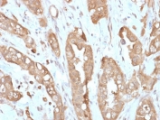 Villin Antibody. Immunohistochemistry analysis of Villin-1 (VIL1) in FFPE human small intestine using Villin Antibody / Epithelial Polarity Marker Antibody with recombinant rabbit monoclonal clone VIL1/2310R. Strong HRP-DAB brown staining is observed along the apical membrane of intestinal epithelial cells, clearly outlining lumen-facing surfaces and emphasizing apical-basal polarity within glandular structures. The predominantly apical membranous pattern highlights organized epithelial polarity and intact lumen formation, consistent with Villin localization as a polarity-defining cytoskeletal protein in absorptive epithelium.