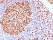MCM7 Antibody Tonsil IHC. Immunohistochemical analysis of MCM7 / Minichromosome maintenance protein 7 in formalin-fixed, paraffin-embedded human tonsil tissue using MCM7 antibody clone MCM7/2832R. Intense nuclear staining is observed in germinal center cells, highlighting proliferative zones, while surrounding lymphocytes show reduced staining, consistent with differential proliferation status.