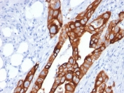 Cytokeratin 20 Antibody for IHC (clone KRT20/1991). Immunohistochemistry analysis of human colon carcinoma tissue using mouse monoclonal Cytokeratin 20 antibody (clone KRT20/1991). HRP-DAB brown chromogenic staining highlights cytoplasmic Keratin 20 / Cytokeratin 20 (KRT20) expression in malignant epithelial cells forming glandular structures, while surrounding stromal cells remain largely negative. The staining pattern reflects the known epithelial localization of this intermediate filament protein in colorectal carcinoma. Required HIER: boil tissue sections in 10 mM citrate buffer, pH 6, for 10-20 min followed by cooling at RT for 20 min.