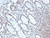 BMI-1 Antibody Colon Cancer IHC. Immunohistochemistry testing of FFPE human colon carcinoma with BMI-1 antibody (clone BMI1/2689). HIER: boil tissue sections in pH6, 10mM citrate buffer, for 10-20 min followed by cooling at RT for 20 min.