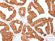 IHC staining of FFPE human prostate with Annexin A1 antibody (clone ANXA1/1671). HIER: boil tissue sections in pH6, 10mM citrate buffer, for 10-20 min and allow to cool before testing.