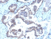 IHC staining of FFPE human prostate carcinoma with biotinylated CD47 antibody (clone CD47/3019). HIER: boil tissue sections in pH 9 10mM Tris with 1mM EDTA for 10-20 min and allow to cool before testing.