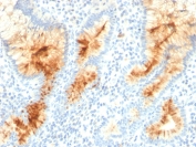 Immunohistochemistry analysis of MUC4 / Mucin-4 antibody (clone MUC4/3105) in human gastric carcinoma tissue. FFPE human gastric carcinoma section shows strong membranous and apical cytoplasmic brown chromogenic staining in malignant epithelial cells forming glandular structures, consistent with MUC4 expression, while surrounding stromal cells show minimal staining and nuclei appear blue. Heat-induced epitope retrieval was performed by steaming tissue sections in 10 mM citrate buffer, pH 6, for 10-20 minutes followed by cooling prior to staining.