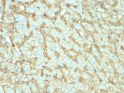 Albumin Antibody Human Hepatocellular Carcinoma Tissue IHC. Immunohistochemistry testing of FFPE human hepatocellular carcinoma with microarray validated Albumin antibody (clone ALB/2142). Required HIER: boil tissue sections in 10mM citrate buffer, pH6, for 10-20 min followed by cooling at RT for 20 min.