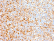 SERBP1 Antibody Urothelial Cancer IHC. Immunohistochemistry analysis of FFPE human urothelial carcinoma tissue stained with SERBP1 Antibody demonstrates widespread cytoplasmic HRP-DAB brown staining across malignant epithelial cell populations, consistent with SERBP1-associated mRNA regulatory and translational control pathway expression. This mRNA binding protein antibody highlights post-transcriptional signaling networks and stress-response-associated cellular regulation within urothelial tumor tissue. Required HIER: boil tissue sections in pH 9 10mM Tris with 1mM EDTA for 10-20 min followed by cooling at RT for 20 min.