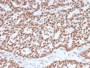 Estrogen Receptor alpha Antibody Human Breast Carcinoma Tissue IHC. Immunohistochemistry of FFPE human breast carcinoma tissue using Estrogen Receptor alpha antibody demonstrates strong HRP-DAB brown nuclear staining in tumor epithelial cells, consistent with ESR1 expression in hormone-responsive breast cancer, while surrounding stromal cells show minimal background; detection was performed with clone ESR1/3557. HIER: boil tissue sections in pH 9 10mM Tris with 1mM EDTA for 10-20 min and allow to cool before testing.