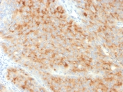 Synaptophysin Antibody Protein Microarray Validated Clone SYP/3551. Immunohistochemistry analysis of FFPE human pancreatic carcinoma using Synaptophysin Antibody Protein Microarray Validated Clone SYP/3551. The recombinant monoclonal antibody clone SYP/3551 produces cytoplasmic staining in tumor cells consistent with Synaptophysin / SYP expression in neuroendocrine differentiated cells. Synaptophysin is a synaptic vesicle membrane glycoprotein widely used as a marker of neuroendocrine differentiation, and the observed cytoplasmic immunoreactivity in pancreatic carcinoma cells aligns with the known localization of SYP within synaptic vesicle membranes. Protein microarray validation of clone SYP/3551 supports selective target recognition, helping confirm specific detection of Synaptophysin protein in immunohistochemistry analysis of formalin-fixed paraffin-embedded tissues.