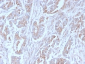 ICOSL Antibody Colon Carcinoma IHC. Immunohistochemistry analysis of FFPE human colon carcinoma tissue stained with clone ICOSL/3111. Tumor epithelial cells demonstrate membranous and cytoplasmic HRP-DAB brown staining consistent with expression of Inducible T-cell costimulator ligand / ICOSLG, an immune checkpoint-associated B7 family ligand involved in adaptive immune regulation and T-cell costimulation signaling within the tumor microenvironment. Stromal connective tissue shows comparatively reduced staining intensity. HIER: boil tissue sections in pH 9 10mM Tris with 1mM EDTA for 10-20 min and allow to cool before testing.