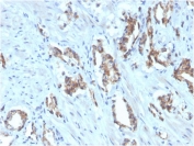 TIGIT Antibody Biotin Conjugate Prostate Carcinoma IHC. Immunohistochemistry staining of FFPE human prostate carcinoma with biotinylated TIGIT antibody (clone TIGIT/3016). HIER: boil tissue sections in pH 9 10mM Tris with 1mM EDTA for 20 min and allow to cool before testing.