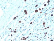 Napsin A Antibody Biotin Conjugate IHC Staining. Immunohistochemistry analysis of Napsin A (NAPSA) expression in FFPE human lung adenocarcinoma demonstrates distinct cytoplasmic HRP-DAB brown staining in tumor epithelial cells with minimal background in surrounding stromal regions. The biotin-conjugated format of clone NAPSA/3308 enables enhanced signal detection through streptavidin-based amplification, supporting sensitive visualization of Napsin A consistent with its role as a pulmonary epithelial differentiation marker. HIER was performed by boiling tissue sections in pH 9 10mM Tris with 1mM EDTA for 20 minutes followed by cooling prior to staining.