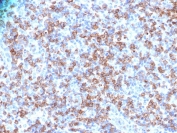 CD8A Antibody Human Lymphoma IHC. Immunohistochemistry analysis of CD8 alpha (CD8A) in FFPE human lymphoma tissue shows strong membranous staining of cytotoxic T lymphocytes within the tumor microenvironment, consistent with CD8-positive cells functioning as effector T cells involved in target cell recognition and elimination. Heat-induced epitope retrieval was performed in pH 9 10 mM Tris with 1 mM EDTA for 10-20 minutes followed by cooling at room temperature.