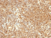 IHC staining of FFPE human lymphoma with CD20 antibody (clone L26). HIER: boil tissue sections in pH 9 10mM Tris with 1mM EDTA for 10-20 min and allow to cool before testing.