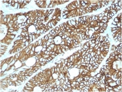 Cadherin 17 Antibody Colon IHC. Immunohistochemistry staining of FFPE human colon tissue using Cadherin 17 Antibody / Liver-Intestine Cadherin Antibody (clone CDH17/2615) demonstrates strong membranous HRP-DAB brown staining throughout colonic epithelial cells lining glandular and crypt structures. The staining pattern is consistent with expression of CDH17 (LI-cadherin), a calcium-dependent cell adhesion molecule that contributes to epithelial organization, maintenance of tissue integrity, and regulation of cell-cell interactions within the gastrointestinal tract. CDH17 is highly expressed in intestinal epithelium and serves as a well-established marker of gastrointestinal epithelial differentiation and lineage. HIER was performed by boiling tissue sections in pH 9, 10 mM Tris with 1 mM EDTA for 10-20 minutes followed by cooling prior to immunostaining.