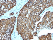 Cadherin 17 Antibody Colon IHC. Immunohistochemistry staining of FFPE human colon tissue using Cadherin 17 Antibody / Epithelial Cell Adhesion Protein Antibody (clone CDH17/2618) demonstrates strong membranous HRP-DAB brown staining throughout colonic epithelial cells lining glandular structures. The staining pattern is consistent with expression of CDH17, a calcium-dependent cell adhesion molecule involved in epithelial organization, maintenance of tissue architecture, and regulation of cell-cell interactions. CDH17 is highly expressed in gastrointestinal epithelium and is widely used as a marker of intestinal epithelial differentiation and epithelial lineage. HIER was performed by boiling tissue sections in pH 9, 10 mM Tris with 1 mM EDTA for 10-20 minutes followed by cooling prior to immunostaining.