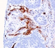 IHC staining of FFPE human colon carcinoma with Nestin antibody (clone NES/2911). HIER: boil tissue sections in pH 9 10mM Tris with 1mM EDTA for 10-20 min and allow to cool before testing.
