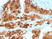 Immunohistochemistry of UPK1A antibody in human urothelial carcinoma. Formalin-fixed, paraffin-embedded human urothelial carcinoma tissue was stained with microarray validated Uroplakin 1A antibody (clone UPK1A/2921) following heat-induced epitope retrieval by boiling in pH 9 10 mM Tris with 1 mM EDTA for 10-20 minutes and cooling prior to testing. HRP-DAB brown chromogenic signal demonstrates strong membranous and cytoplasmic staining in malignant urothelial cells, consistent with urothelial differentiation and the characteristic apical membrane-associated expression pattern of Uroplakin 1A, while surrounding stromal elements remain largely negative.
