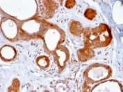 ZNF690 Antibody Breast Carcinoma Immunohistochemistry. IHC staining of FFPE human breast carcinoma with ZNF690 antibody (clone ZSCAN29/2610). HIER: boil tissue sections in pH 9 10mM Tris with 1mM EDTA for 10-20 min and allow to cool before testing.