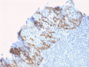 ZNF690 Antibody Breast Carcinoma Tissue IHC. Immunohistochemistry testing of FFPE human breast carcinoma with ZNF690 antibody (clone ZSCAN29/2610). HIER: boil tissue sections in pH 9 10mM Tris with 1mM EDTA for 10-20 min and allow to cool before testing.