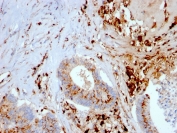 Cathepsin D Antibody Liver Carcinoma IHC. Immunohistochemistry analysis of FFPE human liver carcinoma tissue using Cathepsin D antibody (clone CTSD/3082) shows strong granular cytoplasmic staining in tumor cells and prominent signal in infiltrating macrophages, consistent with CTSD / Cathepsin D localization in lysosomal compartments. The punctate staining pattern reflects lysosomal protease activity associated with intracellular protein degradation and tumor-associated macrophage function. Tumor architecture is preserved, and hematoxylin counterstain provides nuclear contrast and structural context. HIER: boil FFPE tissue sections in pH 9 10 mM Tris with 1 mM EDTA for 10-20 min and allow to cool before testing.