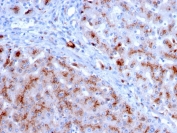 Cathepsin D Antibody FFPE Liver IHC Analysis. Immunohistochemistry staining of FFPE human liver with Cathepsin D antibody (clone CTSD/3083). HIER: boil tissue sections in pH 9 10mM Tris with 1mM EDTA for 10-20 min and allow to cool before testing.