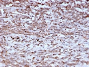 Cathepsin K Antibody Hepatocellular Carcinoma IHC. Immunohistochemistry analysis of FFPE human hepatocellular carcinoma using Cathepsin K antibody (clone CTSK/2793) shows granular cytoplasmic staining in tumor cells, consistent with CTSK / Cathepsin K localization in lysosomal compartments, with variable intensity across the tumor field. The punctate staining pattern reflects lysosomal protease activity associated with extracellular matrix remodeling in malignant tissue. Tumor architecture is preserved, and hematoxylin counterstain provides nuclear contrast and structural context. HIER: boil FFPE tissue sections in pH 9 10 mM Tris with 1 mM EDTA for 10-20 min and allow to cool before testing.