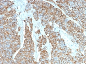 Drebrin 1 Antibody Neuroendocrine Tumor Immunohistochemistry. IHC staining of FFPE human neuroendocrine tumor with Drebrin 1 antibody (clone DBN1/3393). HIER: boil tissue sections in pH 9 10mM Tris with 1mM EDTA for 10-20 min followed by cooling at RT for 20 min.