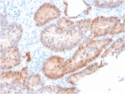 AKR1C2 Antibody Prostate Tumor Gland IHC. Immunohistochemistry analysis of FFPE human prostate carcinoma tissue using AKR1C2 Antibody (clone CPTC-AKR1C2-1) shows cytoplasmic staining in tumor epithelial cells lining glandular structures, consistent with AKR1C2 / Aldo-keto reductase family 1 member C2 localization as a cytosolic enzyme involved in hormone metabolism. The staining highlights glandular architecture with moderate intensity across epithelial cells, while surrounding stromal regions display comparatively lower signal. Hematoxylin counterstain provides nuclear contrast and tissue context. HIER: boil FFPE tissue sections in pH 9 10 mM Tris with 1 mM EDTA for 10-20 min and allow to cool before testing.
