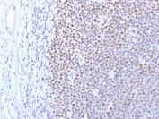 DNA Methyltransferase 1 Antibody Human Tonsil IHC. Immunohistochemistry staining of FFPE human tonsil using DNA Methyltransferase 1 antibody demonstrates strong nuclear staining throughout the lymphoid compartment, consistent with the expected localization of DNMT1 as a nuclear DNA methylation maintenance enzyme. DNMT1 functions to preserve genomic methylation patterns during DNA replication and plays a critical role in epigenetic regulation, chromatin organization, and transcriptional control. The prominent nuclear staining observed within proliferative tonsillar lymphocytes is consistent with the established role of DNMT1 in maintaining cellular identity and epigenetic stability in actively dividing cell populations. HIER: boil tissue sections in pH 9 10mM Tris with 1mM EDTA for 10-20 min and allow to cool before testing.