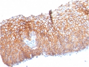 Immunohistochemistry of DSG3 Antibody - Microarray Validated clone DSG3/2840 in human esophageal carcinoma tissue. Formalin-fixed, paraffin-embedded esophageal carcinoma demonstrates strong membranous staining of tumor epithelial cells, consistent with Desmoglein 3 localization at desmosomal cell-cell junctions in stratified squamous epithelium-derived malignancy. Heat-induced epitope retrieval was performed by boiling tissue sections in pH 9 10mM Tris with 1mM EDTA for 10-20 minutes followed by cooling prior to staining. The microarray validated monoclonal antibody clone DSG3/2840 was used as the primary antibody.