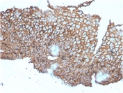 IHC staining of FFPE human esophageal carcinoma with DSG3 antibody-microarray validated clone DSG3/2840. HIER: boil tissue sections in pH 9 10mM Tris with 1mM EDTA for 10-20 min and allow to cool before testing.