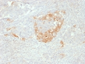 NSE Antibody human neuroendocrine tumor IHC staining. Immunohistochemistry analysis of FFPE human neuroendocrine tumor tissue using NSE Antibody clone NSE-P2 demonstrates cytoplasmic HRP-DAB brown staining in tumor cells consistent with neuroendocrine differentiation, while surrounding stromal cells remain largely negative. The staining pattern highlights tumor cell populations with neuronal or neuroendocrine lineage, supporting its use as a neuroendocrine marker in tissue-based analysis. Heat-induced epitope retrieval was performed using pH 9 Tris-EDTA buffer for 10-20 min prior to staining.