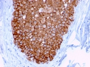 HER2 Antibody Breast Carcinoma Membrane IHC. Immunohistochemistry analysis of FFPE human breast carcinoma tissue using HER2 Antibody (clone ERBB2/3078) demonstrates strong HRP-DAB brown membranous staining outlining tumor epithelial cells, consistent with detection of ErbB2 / HER2 within an extracellular region of this cell surface receptor, while surrounding stromal tissue shows minimal signal; nuclei are counterstained blue. HIER: boil tissue sections in pH 9 10 mM Tris with 1 mM EDTA for 10-20 min and allow to cool before testing.