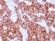 HER2 Antibody Breast Tumor Surface IHC. Immunohistochemistry analysis of FFPE human breast carcinoma tissue using HER2 Antibody (clone ERBB2/3078) highlights continuous HRP-DAB brown membranous staining across tumor cell clusters, emphasizing cell surface localization of ErbB2 / HER2 consistent with an antibody generated against an extracellular portion of the receptor, while adjacent stromal regions remain largely negative; nuclei are counterstained blue. HIER: boil tissue sections in pH 9 10 mM Tris with 1 mM EDTA for 10-20 min and allow to cool before testing.