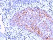 HER2 Antibody Breast Tumor Focal IHC. Immunohistochemistry analysis of FFPE human breast carcinoma tissue using HER2 Antibody (clone ERBB2/3078) demonstrates moderate to strong HRP-DAB brown membranous staining in focal tumor regions, consistent with variable ErbB2 / HER2 expression at the cell surface and detection within an extracellular region of the receptor, while surrounding stromal components show minimal background staining; nuclei are counterstained blue. HIER: boil tissue sections in pH 9 10 mM Tris with 1 mM EDTA for 10-20 min and allow to cool before testing.