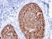 HER2 Antibody Breast Carcinoma IHC. Immunohistochemistry analysis of FFPE human breast carcinoma tissue using HER2 Antibody (clone ERBB2/3079) demonstrates strong HRP-DAB brown membranous staining in tumor epithelial cells forming cohesive nests, consistent with ErbB2 / HER2 overexpression as a receptor tyrosine kinase, while surrounding stromal tissue shows minimal signal; nuclei are counterstained blue. HIER: boil tissue sections in pH 9 10 mM Tris with 1 mM EDTA for 10-20 min and allow to cool before testing.