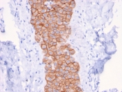HER2 Antibody Breast Tumor Columnar IHC. Immunohistochemistry analysis of FFPE human breast carcinoma tissue using HER2 Antibody (clone ERBB2/3079) highlights intense, continuous HRP-DAB brown membranous staining along elongated tumor cell structures, emphasizing cell surface localization of ErbB2 / HER2 within organized epithelial arrangements, while adjacent stromal regions remain largely negative; nuclei are counterstained blue. HIER: boil tissue sections in pH 9 10 mM Tris with 1 mM EDTA for 10-20 min and allow to cool before testing.