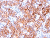 HER2 Antibody Breast Tumor Architecture IHC. Immunohistochemistry analysis of FFPE human breast carcinoma tissue using HER2 Antibody (clone ERBB2/3079) demonstrates widespread HRP-DAB brown membranous staining across complex tumor glandular architecture, consistent with high-level ErbB2 / HER2 expression as a membrane-associated receptor tyrosine kinase, while stromal components show minimal background staining; nuclei are counterstained blue. HIER: boil tissue sections in pH 9 10 mM Tris with 1 mM EDTA for 10-20 min and allow to cool before testing.