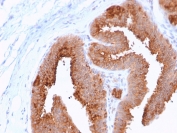 HER4 Antibody Breast Carcinoma Glandular IHC. Immunohistochemistry analysis of FFPE human breast carcinoma stained with a mouse monoclonal HER4 antibody (clone ERBB4/2581) shows strong HRP-DAB brown membranous and cytoplasmic staining in tumor epithelial cells forming glandular structures, consistent with ERBB4 expression, while surrounding stromal regions display minimal background; heat-induced epitope retrieval was performed in pH 9 Tris-EDTA buffer.