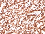 Estrogen Receptor alpha Antibody Breast Carcinoma IHC. Immunohistochemistry of FFPE human breast carcinoma tissue using Estrogen Receptor alpha antibody shows strong HRP-DAB brown nuclear staining in tumor epithelial cells, consistent with ESR1 expression in hormone-responsive breast cancer, while surrounding stromal cells display minimal background; detection was performed with clone ESR1/3559. HIER: boil tissue sections in pH 9 10mM Tris with 1mM EDTA for 10-20 min and allow to cool before testing.
