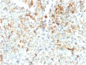 FCGRT Antibody Testicular Cancer IHC. Immunohistochemistry analysis of FFPE human testicular cancer tissue stained with FCGRT Antibody / Neonatal Fc Receptor clone FCGRT/2932 following HIER in pH 9 Tris-EDTA buffer. HRP-DAB brown cytoplasmic and membranous staining is observed in malignant cell populations, consistent with expression of FcRn/FCGRT, an IgG transport receptor involved in antibody recycling, Fc-mediated transport, and regulation of immunoglobulin homeostasis.