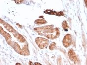 CD135 Antibody Breast Carcinoma Immunohistochemistry. IHC staining of FFPE human breast carcinoma with CD135 antibody (clone FLT3/2458). HIER: boil tissue sections in pH 9 10mM Tris with 1mM EDTA for 10-20 min and allow to cool before testing.