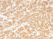 ICOS Ligand Antibody Colon Carcinoma IHC. Immunohistochemistry analysis of FFPE human colon carcinoma tissue stained with clone ICOSL/3260. Tumor epithelial cells display diffuse membranous and cytoplasmic HRP-DAB brown staining consistent with expression of Inducible T-cell costimulator ligand / ICOSLG, an immune checkpoint-associated B7 family ligand involved in adaptive immune signaling and regulation of T-cell activation within the tumor microenvironment. Stromal elements demonstrate comparatively weaker background staining. HIER: boil tissue sections in pH 9 10mM Tris with 1mM EDTA for 10-20 min and allow to cool before testing.
