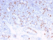 IHC staining of FFPE human breast carcinoma with Estrogen Receptor alpha antibody (clone ESR1/3373). HIER: boil tissue sections in pH 9 10mM Tris with 1mM EDTA for 10-20 min and allow to cool before testing.