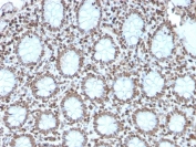 Histone H1 Antibody for IHC. Immunohistochemistry analysis of replication-associated histone H1 expression in FFPE human colon carcinoma tissue using Histone H1 Antibody. Nuclear HRP-DAB brown staining is observed in tumor epithelial cells, consistent with localization of linker histone H1 within chromatin and its role in chromatin organization during replication-coupled chromatin assembly. The recombinant rabbit clone AE-4 antibody demonstrates strong nuclear compartmentalization with minimal cytoplasmic staining, reflecting chromatin-associated distribution in proliferative tumor regions.
